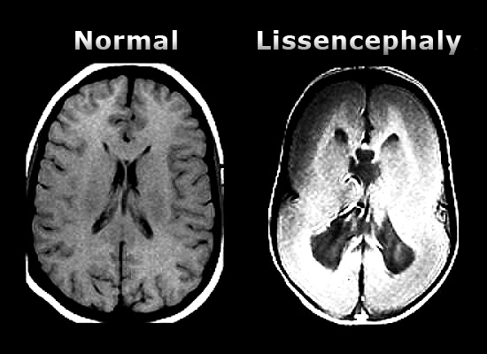 people with lissencephaly